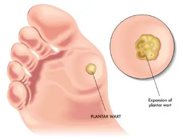 Home Remedies For Plantar Warts